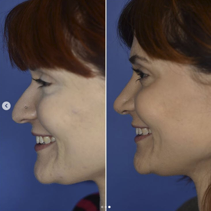 plastic surgeon rhinoplasty specialist